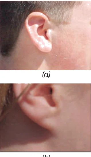 Free and attached earlobes