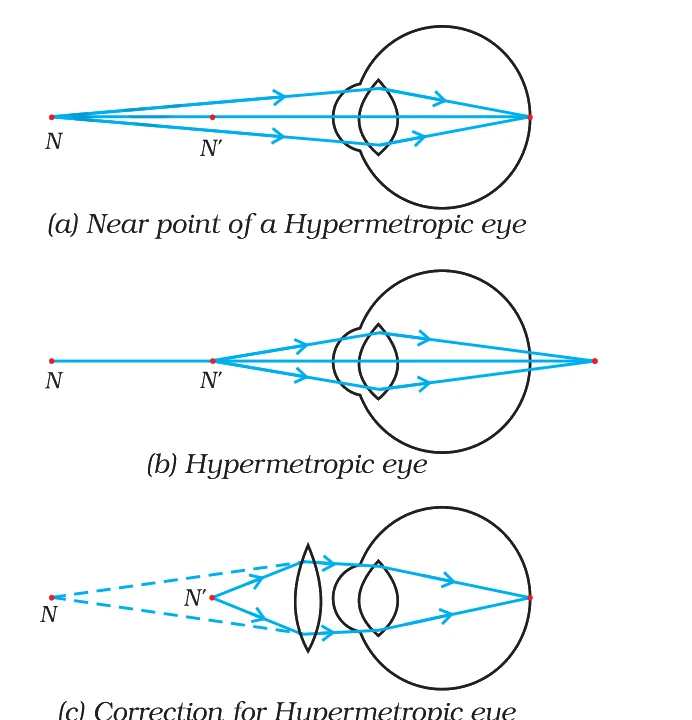 The hypermetropic eye and its correction — (a) near point beyond normal, (b) near image formed behind the retina, (c) a convex lens brings it onto the retina