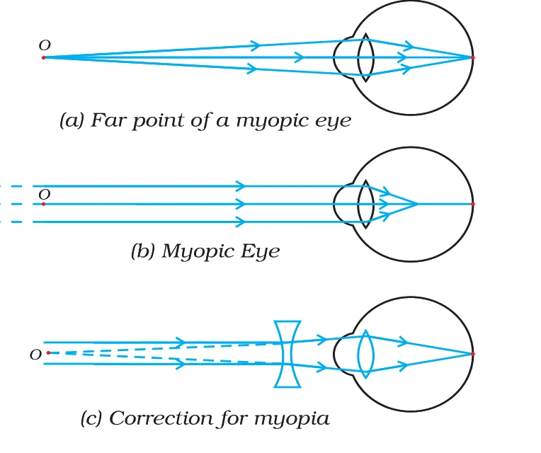The myopic eye and its correction — (a) far point, (b) image formed in front of the retina, (c) a concave lens brings it back onto the retina